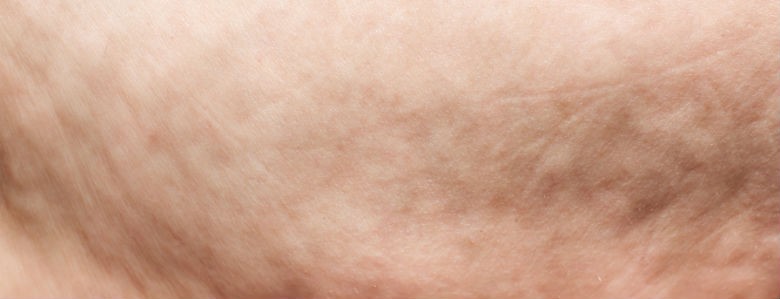 Will Losing Weight Reduce My Cellulite?