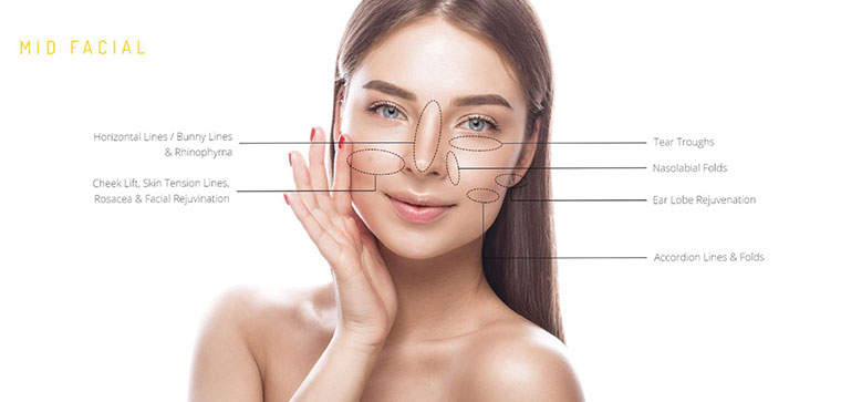 plasma pen treatment areas shown on lady's face